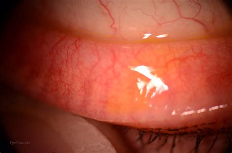 Meibomian Gland Cancer