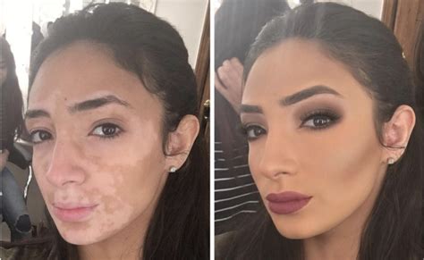 Makeup Artist With Vitiligo Posts Transformation