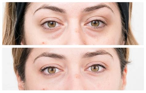 Everything you need to know about non-surgical eye bag removal