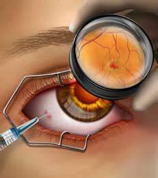 Avastin Eye Injection For Diabetic Retinopathy - DiabetesWalls