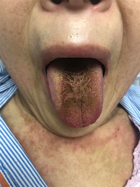 A blackish discoloration on the central part of the dorsal tongue in ...