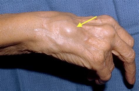 DORSAL TENOSYNOVITIS | Hand Surgery Resource