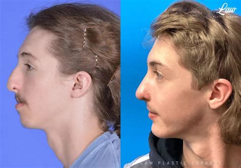 Jaw Surgery (LeFort 1, BSSO, Genioplasty), Cleft Rhinoplasty - Before ...