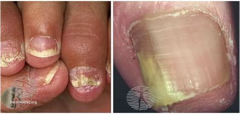 Nail Psoriasis vs. Nail Fungus: Photos and 5 Differences | MyPsoriasisTeam