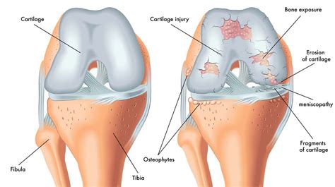 Osteoarthritis | Physiotherapy Manly