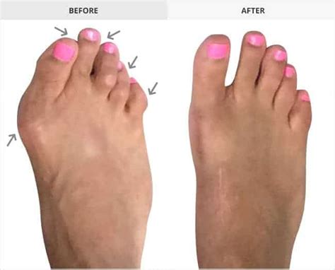 Hammer Toe Before And After