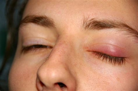 Chalazion – Symptoms, Causes, and Treatments - Fraser Valley Cataract & Laser