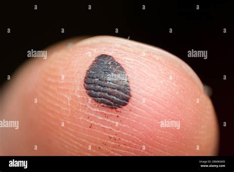 Blood blister hi-res stock photography and images - Alamy