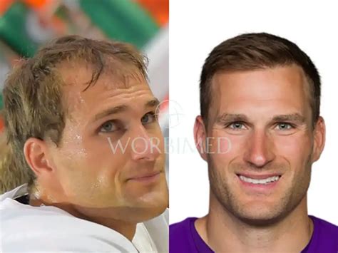 Kirk Cousins Hair Transplant | Before and After