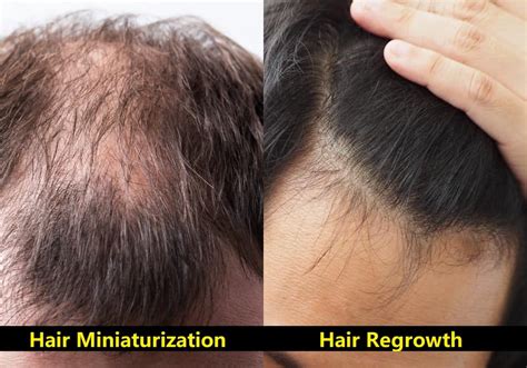 Hair Miniaturization – Signs & Non-Surgical Solution