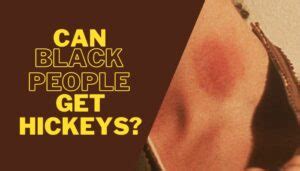 Can Black People Get Hickeys? What You Wish You Knew!