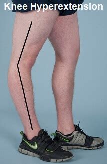 Hyperextended Knee: Causes, Injuries & Treatment - Knee Pain Explained (2024)