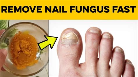 How to Cure Nail Fungus – 2 Home Remedies for Toenail Fungus that ...