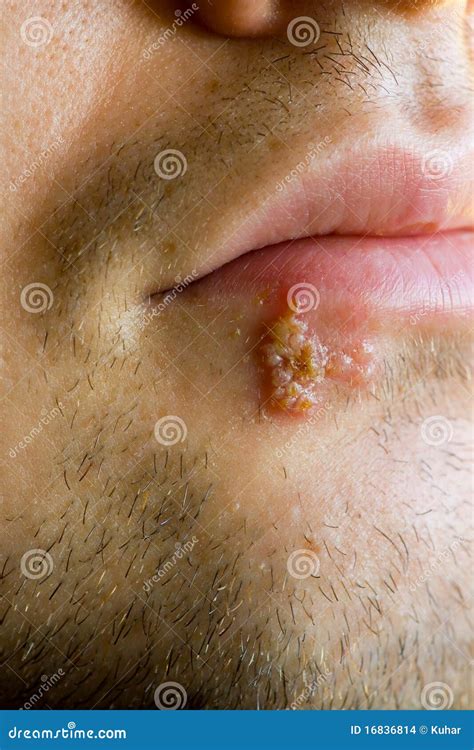 Cold Sores (herpes Labialis) Stock Photo - Image of swollen, illness: 16836814