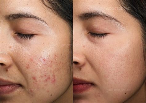 What Causes Cystic Acne? Here’s Everything You Need To Know