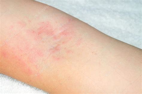 allergy to red rash on the arms — Stock Photo © oatsung #118922030