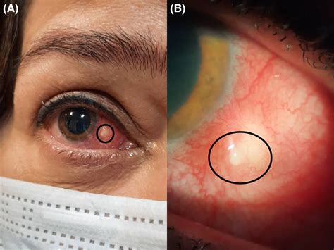 Recurring nodular scleritis following inactivated vaccination for COVID ...