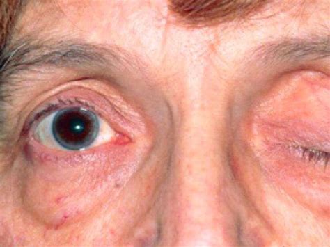 Myasthenia Gravis: 10 Symptoms of Myasthenia Gravis