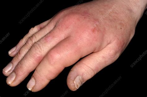 Cellulitis Finger