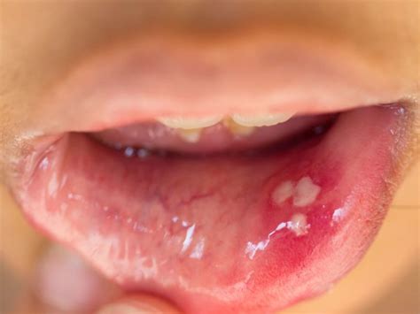 Hpv Corner Of Mouth