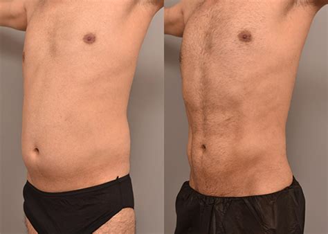 Lipo 360 with Liposculpture in Men Case #240