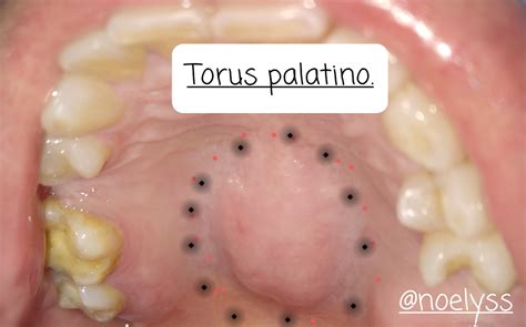 Let's talk about palatal torus. | Hablemos del torus palatino. — Hive