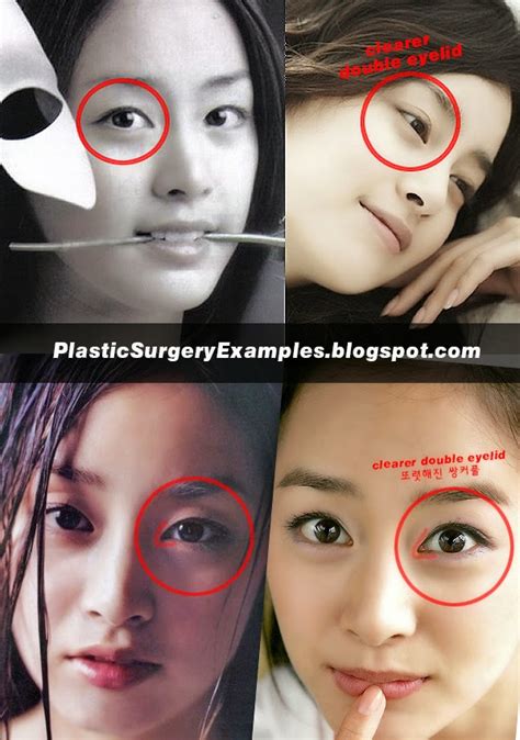 Plastic Surgery Examples: Kim Tae Hee plastic surgery before & after ...