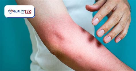 When is Sunburn a Medical Emergency? | Quality Care ER