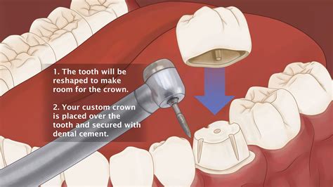 Dental Crown - Brazoria, TX - Osga Dental - Dr. Adam Osga - Dentist