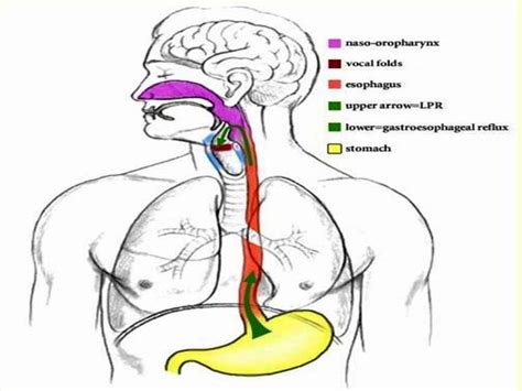 Laryngo pharyngeal reflux (lpr)