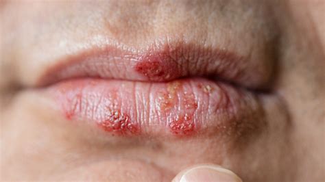 Rash On Lips Herpes - Infoupdate.org