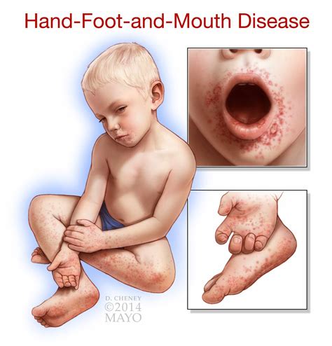 What are the best ways to treat a toddler with hand-foot-and-mouth ...