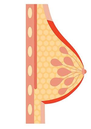 Inflammatory Breast Cancer Rash | Moffitt