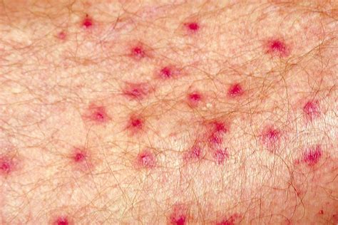 Swimmers itch rash - scapesmyte