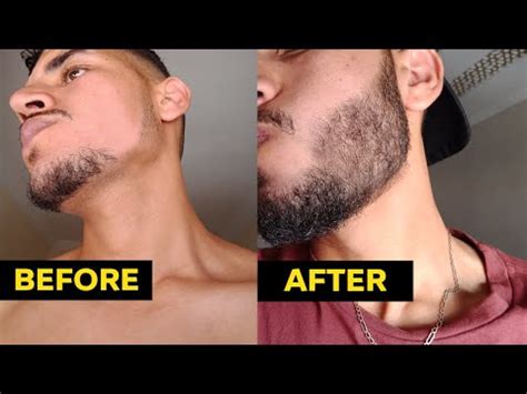 Minoxidil Before And After Beard