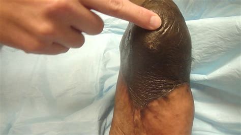 Right Posterior Heel Degloving Wound MatriStem - YouTube