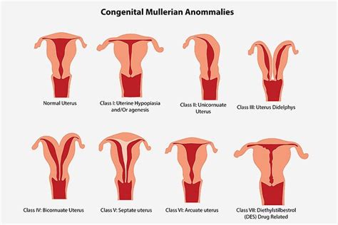 Congenital Uterine Anomalies | KJK Hospital & Fertility Research Centre, Trivandrum