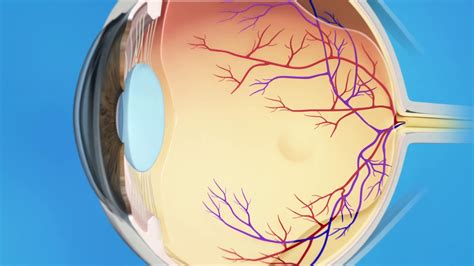 Retina Macular Hole Surgery - YouTube