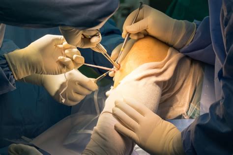 ACL Surgery Is Not Cost Effective in New Study - Regenexx