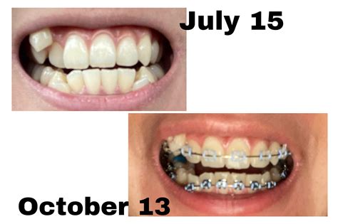 Braces 3 month progress : braces