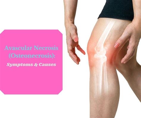 Avascular Necrosis (Osteonecrosis): Symptoms and Causes