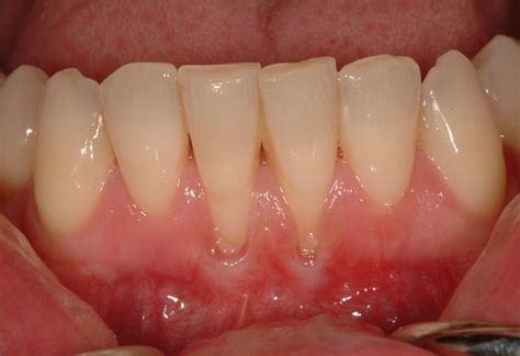 Robert Devoll, DDS, PhD Gingival Recession Demystified