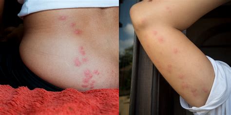 Bed Bug Bites Pictures, Symptoms: What Do Bed Bug Bites Look Like?