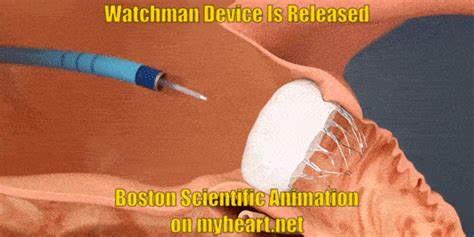 Watchman Device – Explained and FAQ’s Answered by a Cardiologist • MyHeart