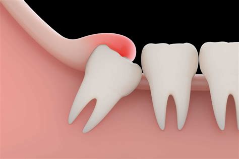 Wisdom Tooth Extraction Pain After Deals | cityofclovis.org