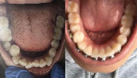 6 Month Progress Pics! : r/braces