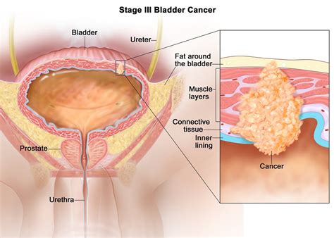 Bladder Cancer - Causes, Symptoms, Signs, Diagnosis, Stages, Treatment