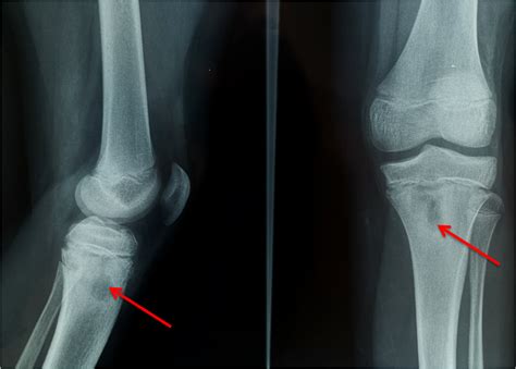 Cureus | Salmonella Osteomyelitis of the Proximal Tibia in a Previously ...