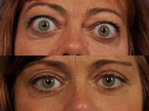 Thyroid Eye Disease Philadelphia | W Cosmetic Surgery