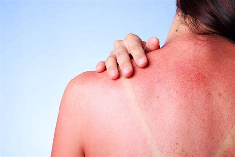 How To Heal A Sunburn - Simple Tips - Mahoney Dermatology